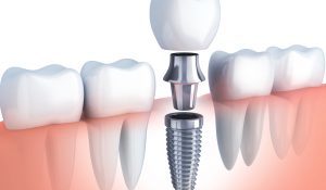 Czy warto zdecydować się na implant zęba ?